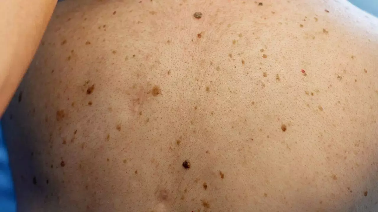 Acne: ఒక్క రాత్రిలో మొటిమలు తగ్గాలంటే ఈ ఇంటి చిట్కా వాడండి.. Acne: ఒక్క రాత్రిలో మొటిమలు తగ్గాలంటే ఈ ఇంటి చిట్కా వాడండి..