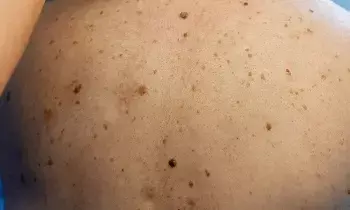 Acne: ఒక్క రాత్రిలో మొటిమలు తగ్గాలంటే ఈ ఇంటి చిట్కా వాడండి.. Acne: ఒక్క రాత్రిలో మొటిమలు తగ్గాలంటే ఈ ఇంటి చిట్కా వాడండి..