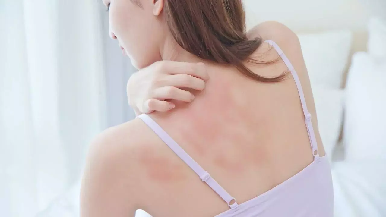 Skin Problems: వర్షాకాలంలో చర్మ సమస్యలతో బాధపడుతున్నారా..? ఈ చిట్కాలు పాటించండి Skin Problems: వర్షాకాలంలో చర్మ సమస్యలతో బాధపడుతున్నారా..? ఈ చిట్కాలు పాటించండి