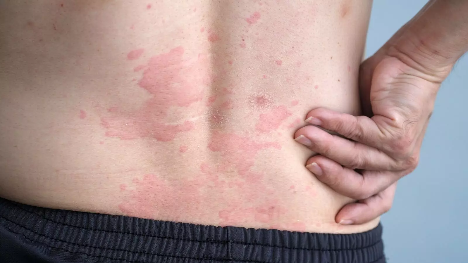 Psoriasis: అలాంటి వాళ్లకు సోరియాసిస్ వచ్చే ప్రమాదం Psoriasis: అలాంటి వాళ్లకు సోరియాసిస్ వచ్చే ప్రమాదం
