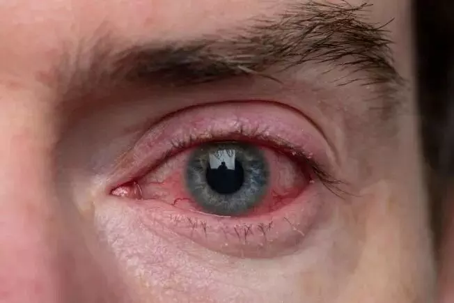 Viral Eye Infections: వైరల్ కంటి ఇన్ఫెక్షన్లకు ఎలాంటి జాగ్రత్తలు తీసుకోవాలో తెలుసా..? Viral Eye Infections: వైరల్ కంటి ఇన్ఫెక్షన్లకు ఎలాంటి జాగ్రత్తలు తీసుకోవాలో తెలుసా..?