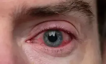 Viral Eye Infections: వైరల్ కంటి ఇన్ఫెక్షన్లకు ఎలాంటి జాగ్రత్తలు తీసుకోవాలో తెలుసా..?