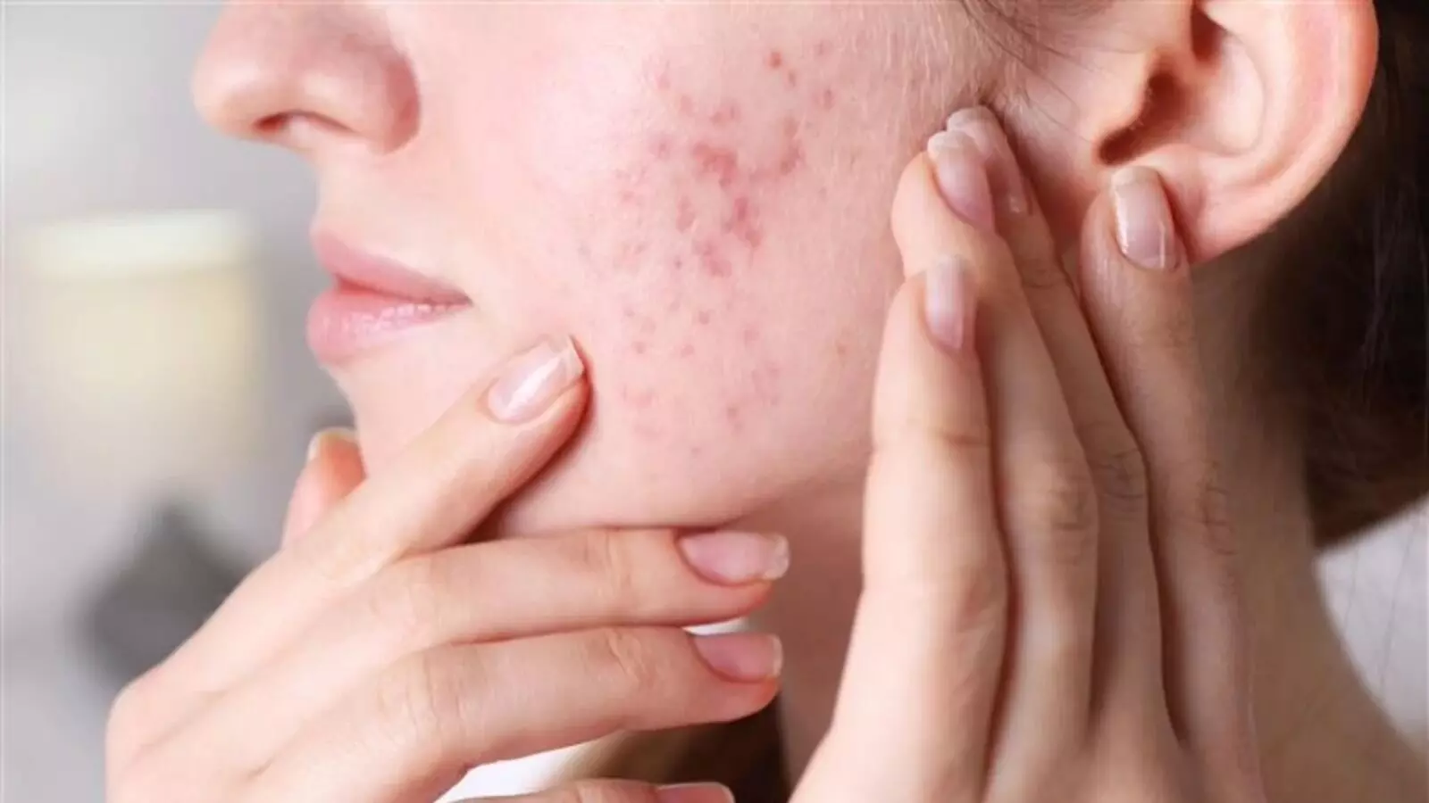 To Reduce Pimples: మొటిమలు తగ్గించే ఇంటి చిట్కాలు To Reduce Pimples: మొటిమలు తగ్గించే ఇంటి చిట్కాలు