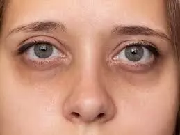 Dark Circles Around Your Eyes: కళ్ళ చుట్టూ బ్లాక్ సర్కిల్స్ పోవాలంటే.. ఈ ట్రిక్స్ పాటించండి.. Dark Circles Around Your Eyes: కళ్ళ చుట్టూ బ్లాక్ సర్కిల్స్ పోవాలంటే.. ఈ ట్రిక్స్ పాటించండి..