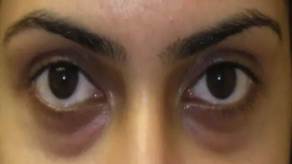 Dark Circles Under the Eyes: కళ్ల కింద నల్లటి డార్క్ సర్కిల్స్ పోవాలంటే Dark Circles Under the Eyes: కళ్ల కింద నల్లటి డార్క్ సర్కిల్స్ పోవాలంటే