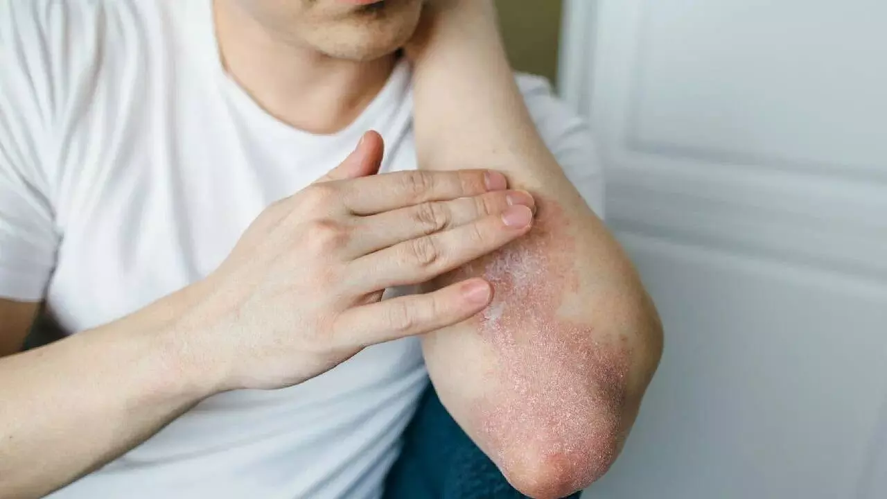 Skin Problems: వర్షాకాలంలో చర్మ సమస్యలు.. ఏం చేయాలంటే..? Skin Problems: వర్షాకాలంలో చర్మ సమస్యలు.. ఏం చేయాలంటే..?