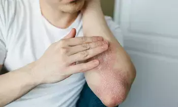 Skin Problems: వర్షాకాలంలో చర్మ సమస్యలు.. ఏం చేయాలంటే..?