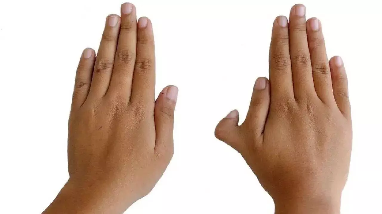 Having Six Fingers on the Right Hand: కుడి చేతిలో ఆరు వేళ్లు ఉంటే అదృష్టమా..? అశుభమా..? Having Six Fingers on the Right Hand: కుడి చేతిలో ఆరు వేళ్లు ఉంటే అదృష్టమా..? అశుభమా..?