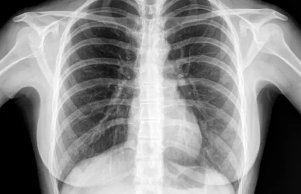 Getting a Chest X-Ray: చెస్ట్ ఎక్స్ రే తీయించుకుంటున్నారా? ఈ విషయం తెలుసుకోండి Getting a Chest X-Ray: చెస్ట్ ఎక్స్ రే తీయించుకుంటున్నారా? ఈ విషయం తెలుసుకోండి