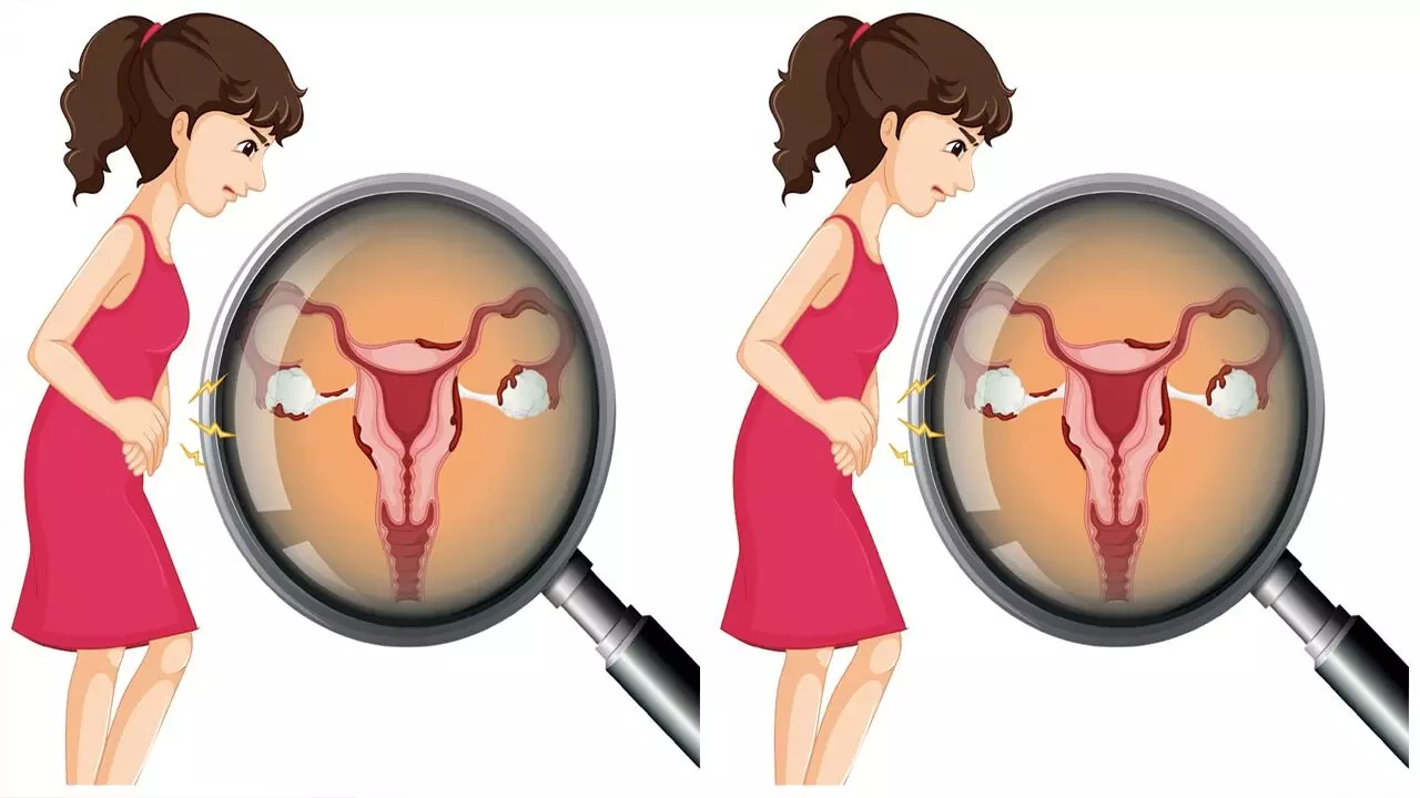Uterus Slip Down: గర్భసంచి కిందికి ఎందుకు జారుతుంది.? Uterus Slip Down: గర్భసంచి కిందికి ఎందుకు జారుతుంది.?