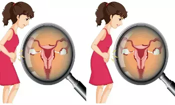 Uterus Slip Down: గర్భసంచి కిందికి ఎందుకు జారుతుంది.?
