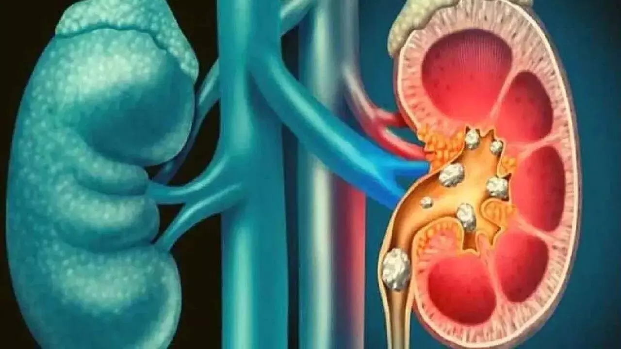 Kidney Stones Recur Again and Again: కిడ్నీలో రాళ్లు మళ్లీ మళ్లీ వస్తున్నాయా? ఈ 5 జాగ్రత్తలతో వాటికి చెక్ పెట్టండి Kidney Stones Recur Again and Again: కిడ్నీలో రాళ్లు మళ్లీ మళ్లీ వస్తున్నాయా? ఈ 5 జాగ్రత్తలతో వాటికి చెక్ పెట్టండి