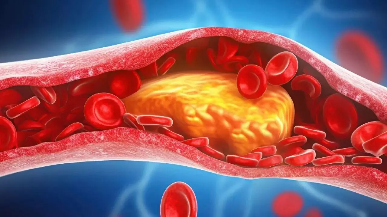 Bad Cholesterol Poses a Threat to the Heart: గుండెకు గండం చెడు కొలెస్ట్రాల్.. ధమనుల్లో పూడికలు పోవాలంటే ఈ ఆహారాలు తప్పనిసరి! Bad Cholesterol Poses a Threat to the Heart: గుండెకు గండం చెడు కొలెస్ట్రాల్.. ధమనుల్లో పూడికలు పోవాలంటే ఈ ఆహారాలు తప్పనిసరి!