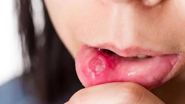Mouth Ulcer: నోటి పూత తగ్గడం లేదా?..ఈ టిప్స్ పాటించండి Mouth Ulcer: నోటి పూత తగ్గడం లేదా?..ఈ టిప్స్ పాటించండి