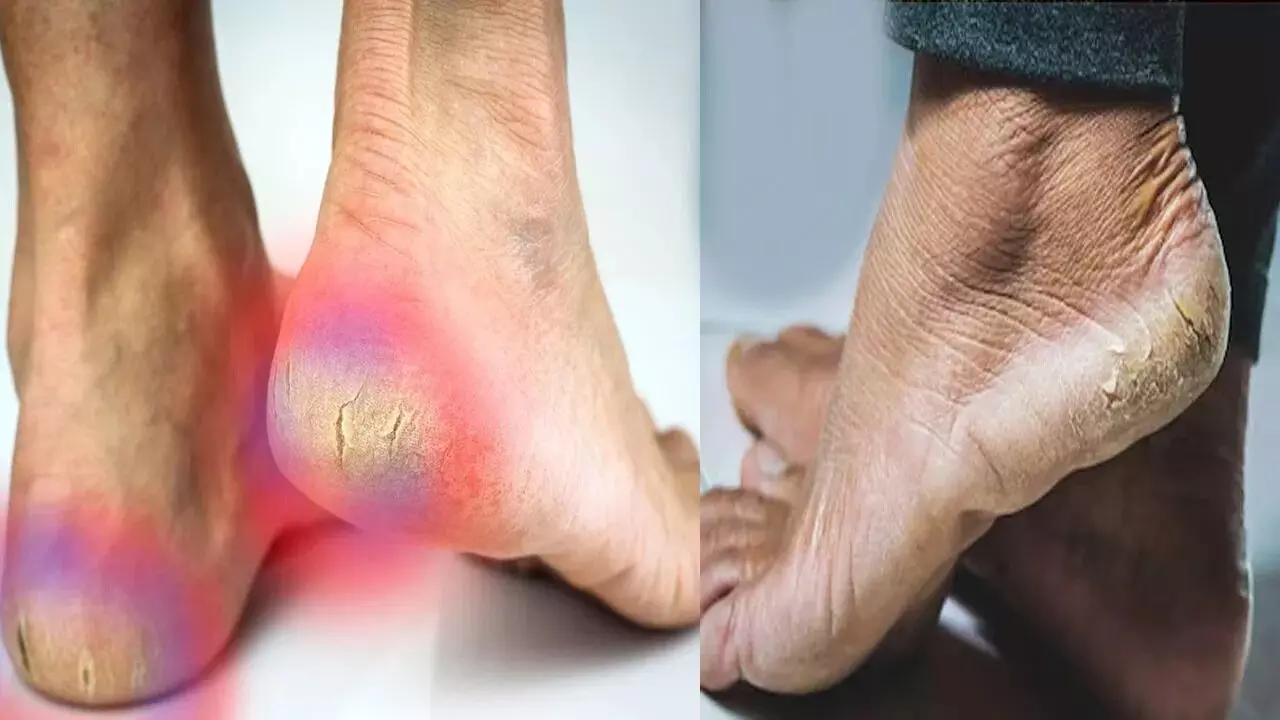 Heels Cracking: మడమలు పగులుతున్నాయా? అయితే ఈ చిట్కా ఫాలోకండి Heels Cracking: మడమలు పగులుతున్నాయా? అయితే ఈ చిట్కా ఫాలోకండి