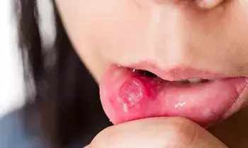 Mouth Ulcer: నోటి పూత తగ్గడం లేదా?..ఈ టిప్స్ పాటించండి Mouth Ulcer: నోటి పూత తగ్గడం లేదా?..ఈ టిప్స్ పాటించండి