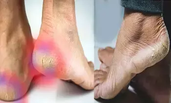 Heels Cracking: మడమలు పగులుతున్నాయా? అయితే ఈ చిట్కా ఫాలోకండి Heels Cracking: మడమలు పగులుతున్నాయా? అయితే ఈ చిట్కా ఫాలోకండి