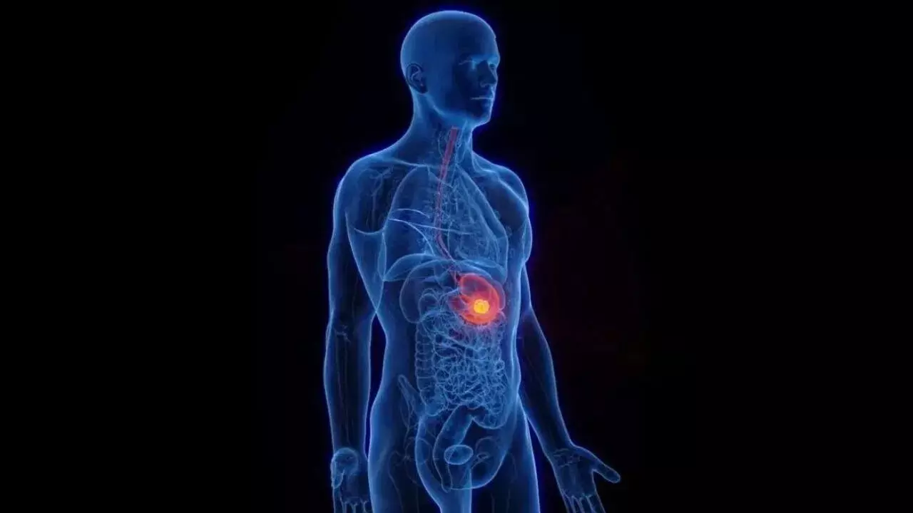 Constipation Lead to Cancer:మలబద్ధకాన్ని నిర్లక్ష్యం చేస్తే క్యాన్సర్ వస్తుందా? Constipation Lead to Cancer:మలబద్ధకాన్ని నిర్లక్ష్యం చేస్తే క్యాన్సర్ వస్తుందా?