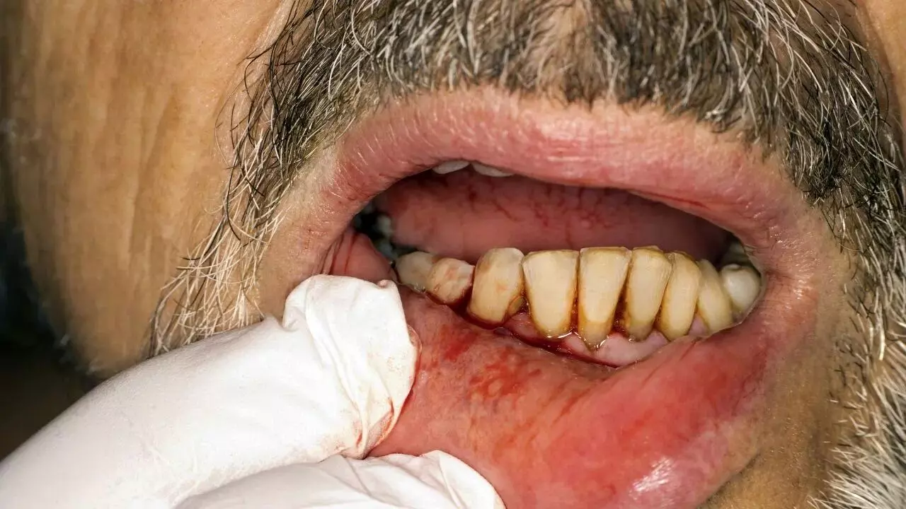 Bleeding Gums: చిగుళ్ల నుండి రక్తం వస్తుందా..? అయితే మీరు ప్రమాదంలో ఉన్నట్లే.. అసలు కారణాలివే Bleeding Gums: చిగుళ్ల నుండి రక్తం వస్తుందా..? అయితే మీరు ప్రమాదంలో ఉన్నట్లే.. అసలు కారణాలివే