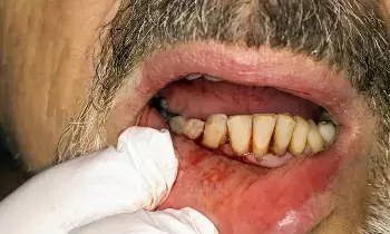 Bleeding Gums: చిగుళ్ల నుండి రక్తం వస్తుందా..? అయితే మీరు ప్రమాదంలో ఉన్నట్లే.. అసలు కారణాలివే Bleeding Gums: చిగుళ్ల నుండి రక్తం వస్తుందా..? అయితే మీరు ప్రమాదంలో ఉన్నట్లే.. అసలు కారణాలివే