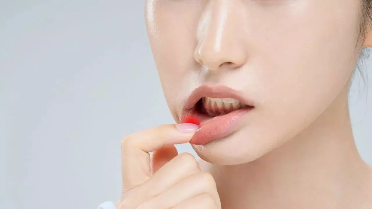 Troubled by Mouth Ulcers: నోటి పూతలతో ఇబ్బంది పడుతున్నారా? పదేపదే వస్తుంటే ప్రాణాంతక వ్యాధి కావచ్చు.. Troubled by Mouth Ulcers: నోటి పూతలతో ఇబ్బంది పడుతున్నారా? పదేపదే వస్తుంటే ప్రాణాంతక వ్యాధి కావచ్చు..