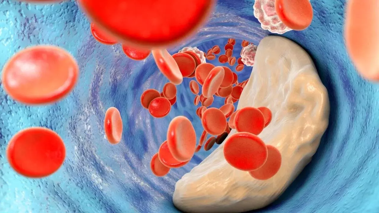 Cholesterol Levels Rise in Winter: శీతాకాలంలో పెరిగే కొలెస్ట్రాల్: మీ ఆరోగ్యం మీ చేతుల్లోనే.. Cholesterol Levels Rise in Winter: శీతాకాలంలో పెరిగే కొలెస్ట్రాల్: మీ ఆరోగ్యం మీ చేతుల్లోనే..