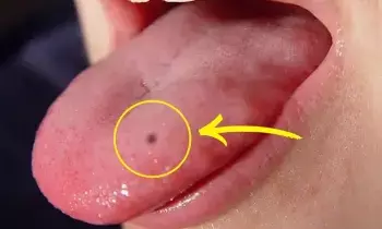 Birthmark on the Tongue: నాలుక పుట్టుమచ్చ ఉంటే.. ఏది చెబితే అది నిజమవుతుందా.? Birthmark on the Tongue: నాలుక పుట్టుమచ్చ ఉంటే.. ఏది చెబితే అది నిజమవుతుందా.?