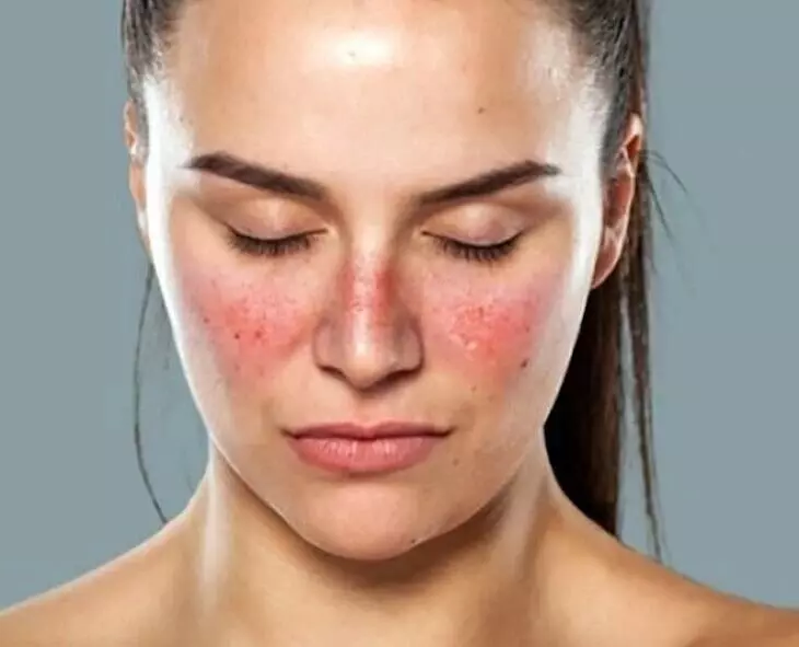 Higher Risk of Lupus in Women: మహిళల్లో అధికంగా లూపస్ ముప్పు: లక్షణాలు ఇవే! Higher Risk of Lupus in Women: మహిళల్లో అధికంగా లూపస్ ముప్పు: లక్షణాలు ఇవే!