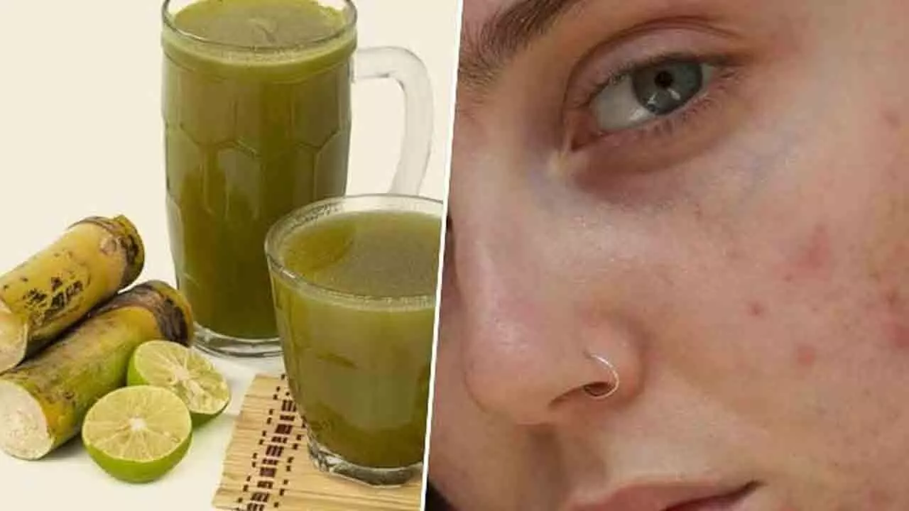 Sugarcane Juice: చెరుకు రసంతో.. మొటిమలకు ఇలా చెక్ పెట్టండి Sugarcane Juice: చెరుకు రసంతో.. మొటిమలకు ఇలా చెక్ పెట్టండి