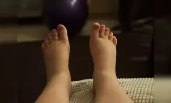 Edema During Pregnancy: ప్రెగ్నెన్సీ టైంలో కాళ్ల వాపు ఎందుకు వస్తదో తెలుసా.? Edema During Pregnancy: ప్రెగ్నెన్సీ టైంలో కాళ్ల వాపు ఎందుకు వస్తదో తెలుసా.?