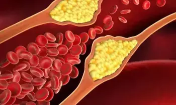 High Cholesterol: కనిపించని శత్రువు హై కొలెస్ట్రాల్: ఈ లక్షణాలను అస్సలు వదిలేయకండి! High Cholesterol: కనిపించని శత్రువు హై కొలెస్ట్రాల్: ఈ లక్షణాలను అస్సలు వదిలేయకండి!