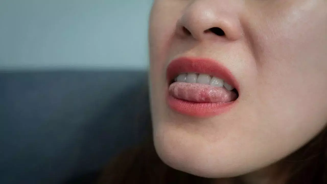 Troubled by Tongue Ulcers: నాలుకపై పుండ్లు వేధిస్తున్నాయా? ఈ చిట్కాలతో చెక్ పెట్టండి.. Troubled by Tongue Ulcers: నాలుకపై పుండ్లు వేధిస్తున్నాయా? ఈ చిట్కాలతో చెక్ పెట్టండి..