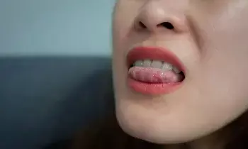 Troubled by Tongue Ulcers: నాలుకపై పుండ్లు వేధిస్తున్నాయా? ఈ చిట్కాలతో చెక్ పెట్టండి.. Troubled by Tongue Ulcers: నాలుకపై పుండ్లు వేధిస్తున్నాయా? ఈ చిట్కాలతో చెక్ పెట్టండి..