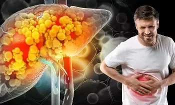 Liver Damage Even Without Alcohol: మద్యం తాగకపోయినా లివర్ ఖరాబ్..? అసలు కారణాలు ఇవే.. Liver Damage Even Without Alcohol: మద్యం తాగకపోయినా లివర్ ఖరాబ్..? అసలు కారణాలు ఇవే..