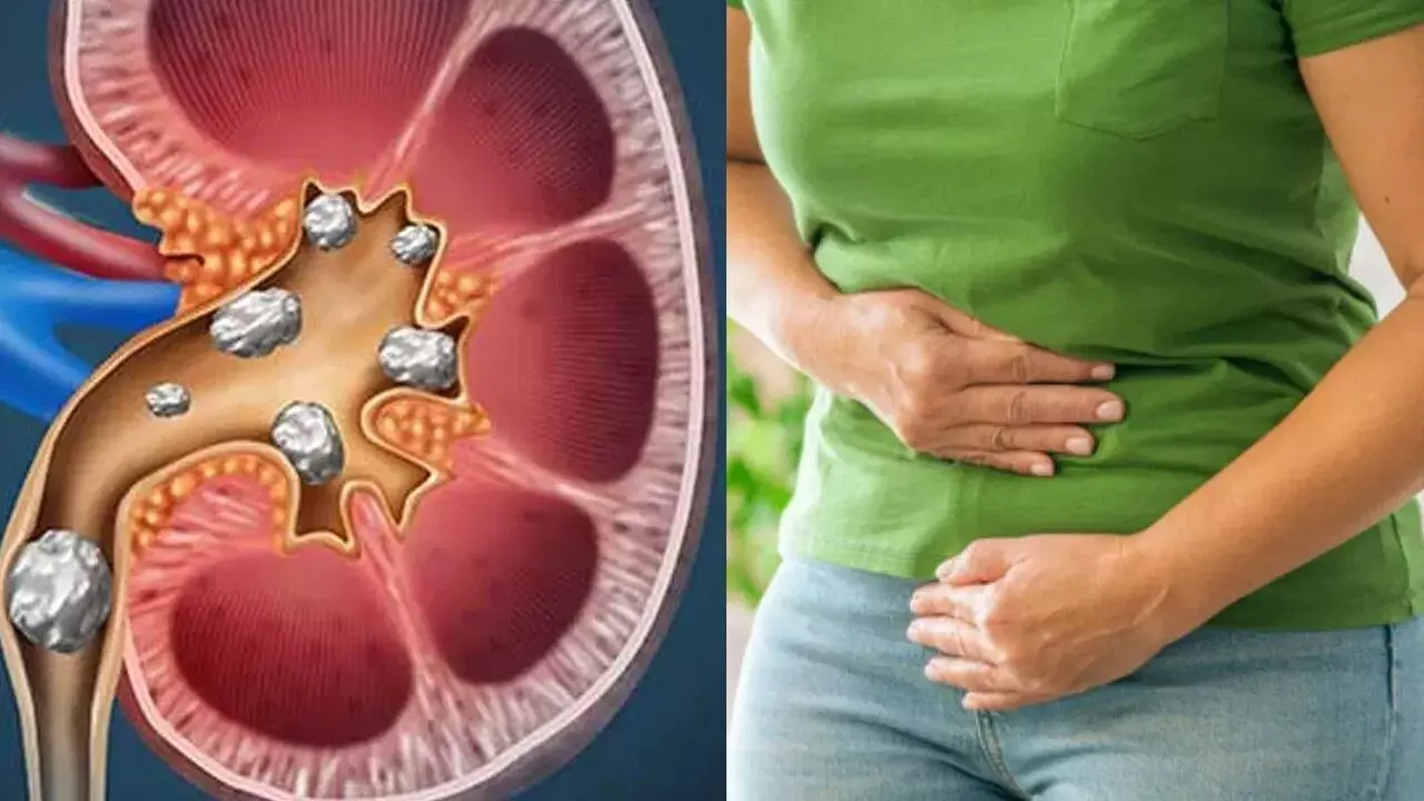 Real Secret Behind Kidney Stones: కిడ్నీ రాళ్ల వెనుక అసలు గుట్టు ఇదా? షాకింగ్ నిజాలు బయటపెట్టిన శాస్త్రవేత్తలు Real Secret Behind Kidney Stones: కిడ్నీ రాళ్ల వెనుక అసలు గుట్టు ఇదా? షాకింగ్ నిజాలు బయటపెట్టిన శాస్త్రవేత్తలు