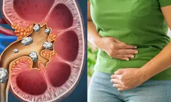 Real Secret Behind Kidney Stones: కిడ్నీ రాళ్ల వెనుక అసలు గుట్టు ఇదా? షాకింగ్ నిజాలు బయటపెట్టిన శాస్త్రవేత్తలు Real Secret Behind Kidney Stones: కిడ్నీ రాళ్ల వెనుక అసలు గుట్టు ఇదా? షాకింగ్ నిజాలు బయటపెట్టిన శాస్త్రవేత్తలు