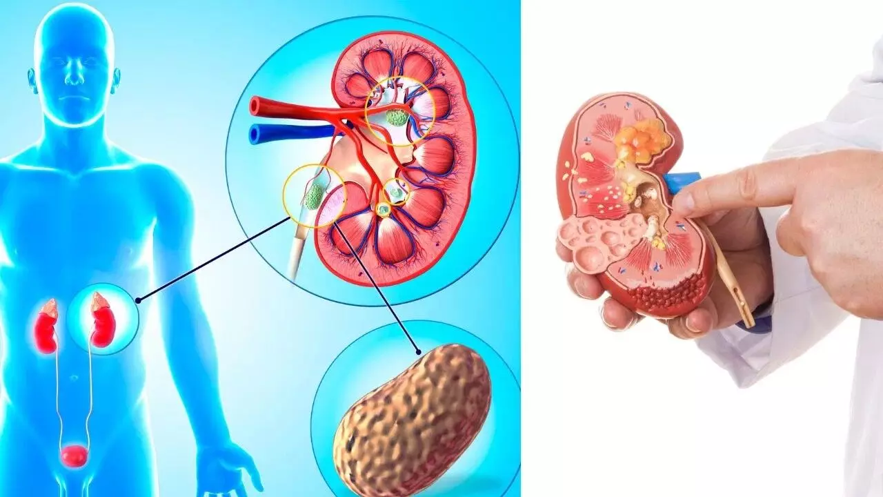 Suffering from Kidney Stones: కిడ్నీలో రాళ్లతో ఇబ్బంది పడుతున్నారా? అయితే ఈ ఆహారాలకు వెంటనే నో చెప్పండి.. Suffering from Kidney Stones: కిడ్నీలో రాళ్లతో ఇబ్బంది పడుతున్నారా? అయితే ఈ ఆహారాలకు వెంటనే నో చెప్పండి..