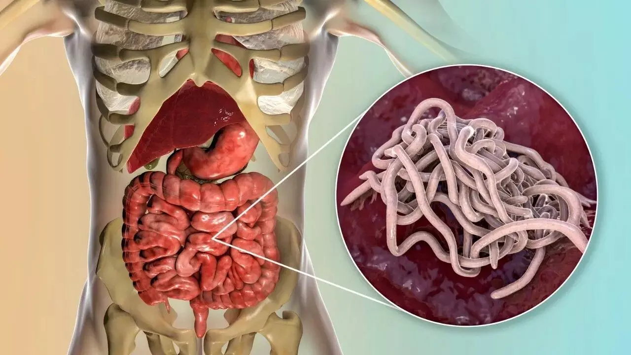 Intestinal Worms Affecting Your Child’s Growth: పిల్లల ఎదుగుదలకు నులిపురుగులు అడ్డంకిగా మారాయా? ఈ లక్షణాలు కనిపిస్తే అప్రమత్తం అవ్వండి.. Intestinal Worms Affecting Your Child’s Growth: పిల్లల ఎదుగుదలకు నులిపురుగులు అడ్డంకిగా మారాయా? ఈ లక్షణాలు కనిపిస్తే అప్రమత్తం అవ్వండి..