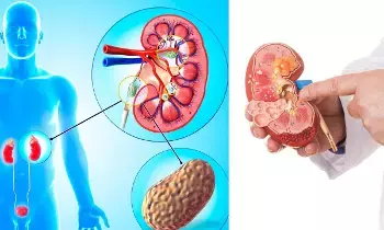 Suffering from Kidney Stones: కిడ్నీలో రాళ్లతో ఇబ్బంది పడుతున్నారా? అయితే ఈ ఆహారాలకు వెంటనే నో చెప్పండి.. Suffering from Kidney Stones: కిడ్నీలో రాళ్లతో ఇబ్బంది పడుతున్నారా? అయితే ఈ ఆహారాలకు వెంటనే నో చెప్పండి..