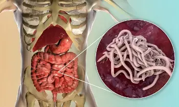 Intestinal Worms Affecting Your Child’s Growth: పిల్లల ఎదుగుదలకు నులిపురుగులు అడ్డంకిగా మారాయా? ఈ లక్షణాలు కనిపిస్తే అప్రమత్తం అవ్వండి.. Intestinal Worms Affecting Your Child’s Growth: పిల్లల ఎదుగుదలకు నులిపురుగులు అడ్డంకిగా మారాయా? ఈ లక్షణాలు కనిపిస్తే అప్రమత్తం అవ్వండి..