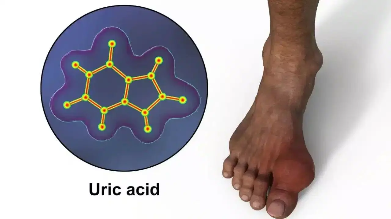 Joint Pains Troubling: కీళ్ల నొప్పులు వేధిస్తున్నాయా? అయితే యూరిక్ యాసిడ్ పెరిగిందేమో చెక్ చేసుకోండి.. Joint Pains Troubling: కీళ్ల నొప్పులు వేధిస్తున్నాయా? అయితే యూరిక్ యాసిడ్ పెరిగిందేమో చెక్ చేసుకోండి..