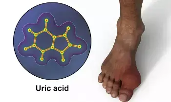 Joint Pains Troubling: కీళ్ల నొప్పులు వేధిస్తున్నాయా? అయితే యూరిక్ యాసిడ్ పెరిగిందేమో చెక్ చేసుకోండి..