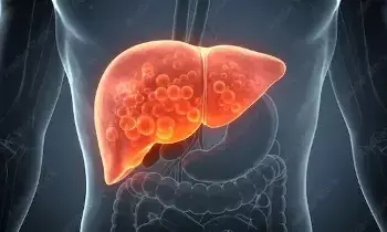 Fatty Liver Problems: ప్రతి ముగ్గురిలో ఒకరికి ఫ్యాటీ లివర్ సమస్య.. కేవలం 3 నెలల్లో సహజంగా ఎలా తగ్గించుకోవాలో తెలుసా..? Fatty Liver Problems: ప్రతి ముగ్గురిలో ఒకరికి ఫ్యాటీ లివర్ సమస్య.. కేవలం 3 నెలల్లో సహజంగా ఎలా తగ్గించుకోవాలో తెలుసా..?