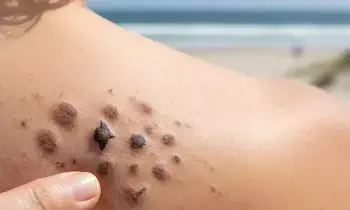 Detect Skin Cancer in Just 4 Days:  వైద్య రంగంలో అద్భుతం.. స్మార్ట్ టాటూతో చర్మ క్యాన్సర్‌కు చెక్.. కేవలం 4 రోజుల్లోనే గుర్తింపు..