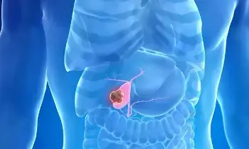 Gallstones Rising Among Youth Under 30: 30 ఏళ్లలోపు యువతలోనే పిత్తాశయ రాళ్లు.. జంక్ ఫుడ్, ఊబకాయమే శాపమా? Gallstones Rising Among Youth Under 30: 30 ఏళ్లలోపు యువతలోనే పిత్తాశయ రాళ్లు.. జంక్ ఫుడ్, ఊబకాయమే శాపమా?