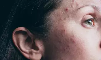 Dark Skin Around the Neck and Persistent Acne: మెడ చుట్టూ నలుపు, తగ్గని మొటిమలా? అది థైరాయిడ్ కావచ్చు జాగ్రత్త..