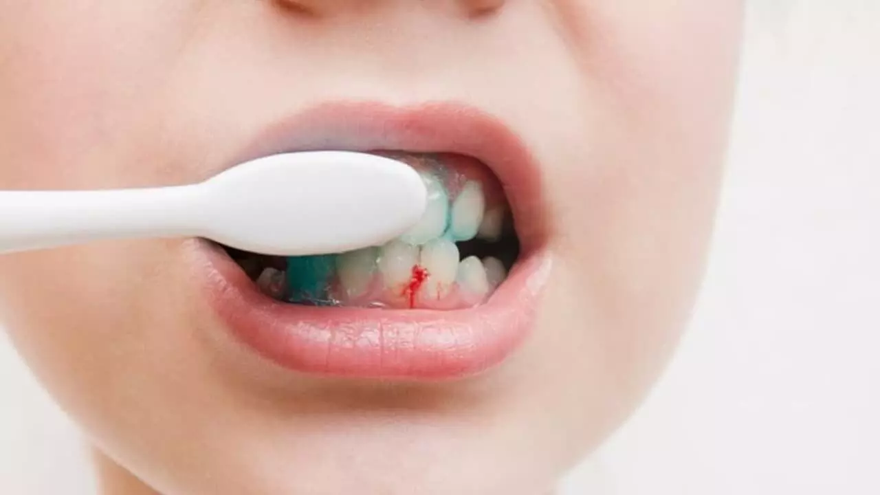 Bleeding While Brushing Your Teeth: బ్రష్ చేసేటప్పుడు రక్తం పడుతోందా?.నిర్లక్ష్యం చేయకండి Bleeding While Brushing Your Teeth: బ్రష్ చేసేటప్పుడు రక్తం పడుతోందా?.నిర్లక్ష్యం చేయకండి