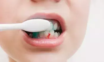 Bleeding While Brushing Your Teeth: బ్రష్ చేసేటప్పుడు రక్తం పడుతోందా?.నిర్లక్ష్యం చేయకండి Bleeding While Brushing Your Teeth: బ్రష్ చేసేటప్పుడు రక్తం పడుతోందా?.నిర్లక్ష్యం చేయకండి