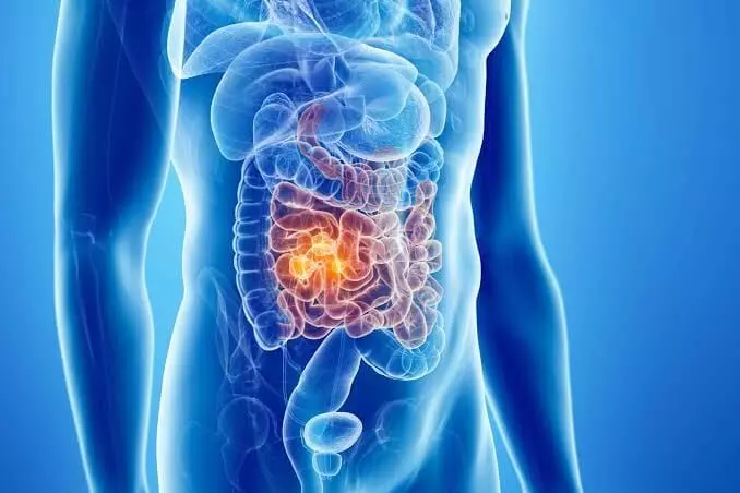 Lower the Risk of Colon Cancer: పేగు క్యాన్సర్కు చెక్ పెట్టాలా? రోజూ మీ ఆహారంలో ఈ 5 వస్తువులు ఉండేలా చూసుకోండి.. Lower the Risk of Colon Cancer: పేగు క్యాన్సర్కు చెక్ పెట్టాలా? రోజూ మీ ఆహారంలో ఈ 5 వస్తువులు ఉండేలా చూసుకోండి..