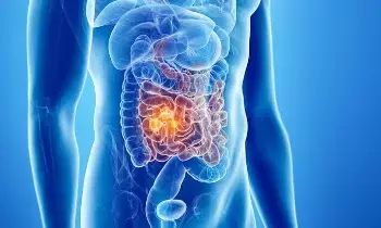 Lower the Risk of Colon Cancer: పేగు క్యాన్సర్కు చెక్ పెట్టాలా? రోజూ మీ ఆహారంలో ఈ 5 వస్తువులు ఉండేలా చూసుకోండి.. Lower the Risk of Colon Cancer: పేగు క్యాన్సర్కు చెక్ పెట్టాలా? రోజూ మీ ఆహారంలో ఈ 5 వస్తువులు ఉండేలా చూసుకోండి..